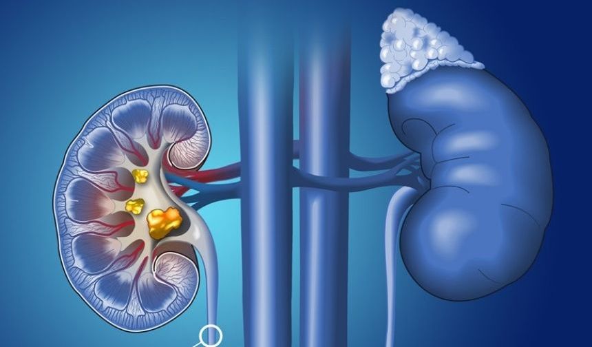 5 MM’NİN ÜSTÜNDEKİ BÖBREK TAŞLARI İÇİN CERRAHİ MÜDAHALE GEREKLİ